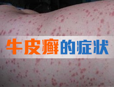 牛皮癣都有什么症状表现