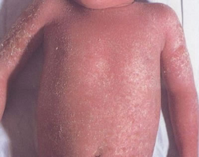 儿童银屑病怎么预防感冒