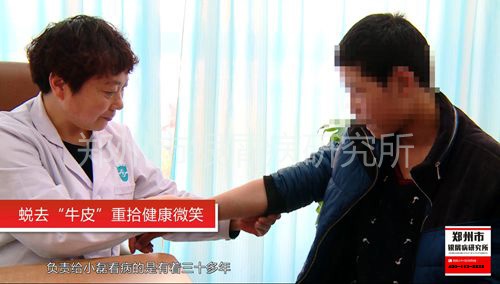 蜕去“牛皮”，重拾健康微笑-2.jpg